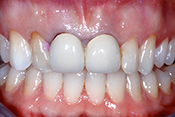 Zwei vollkeramische Frontzahnkronen (mittlere Schneidezähne) und zwei Veneers auf seitlichen Schneidezähnen